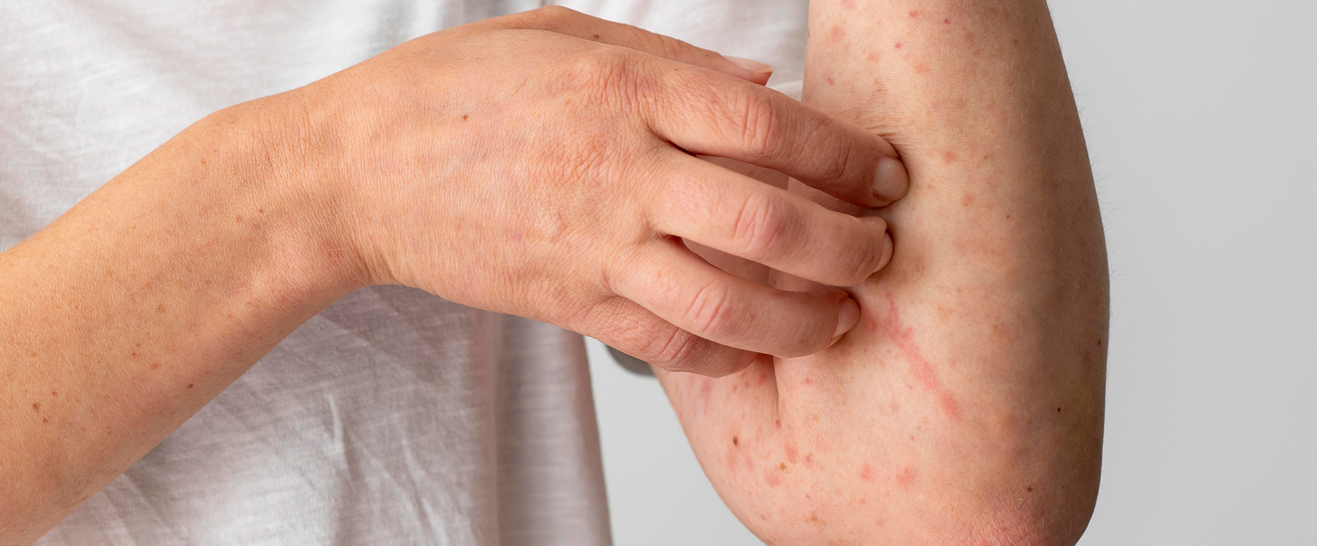 food-allergies-how-to-diagnose